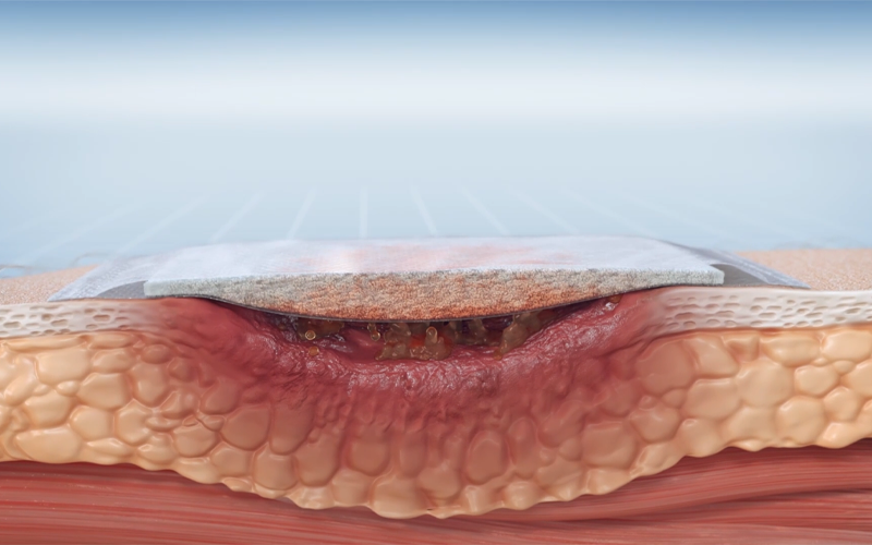 This video shows how Cutimed Sorbion’s excellent exudate management is made possible by the Hydration Response Technology. This video shows how Cutimed Sorbion’s excellent exudate management is made possible by the Hydration Response Technology.